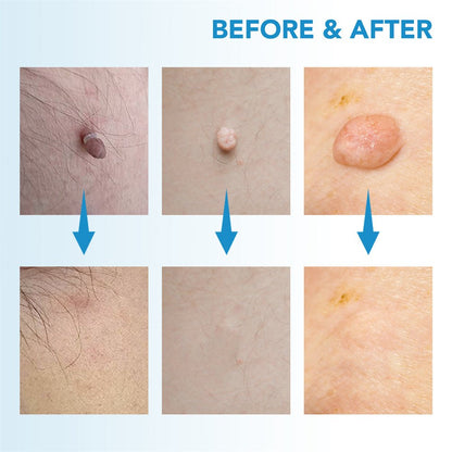 BowLift | EPICLEAR – At-Home Skin Tag & Wart Remover Kit
