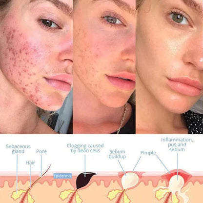 Skanto | Professional High Frequency Wand – Anti-Aging and Skin Renewal