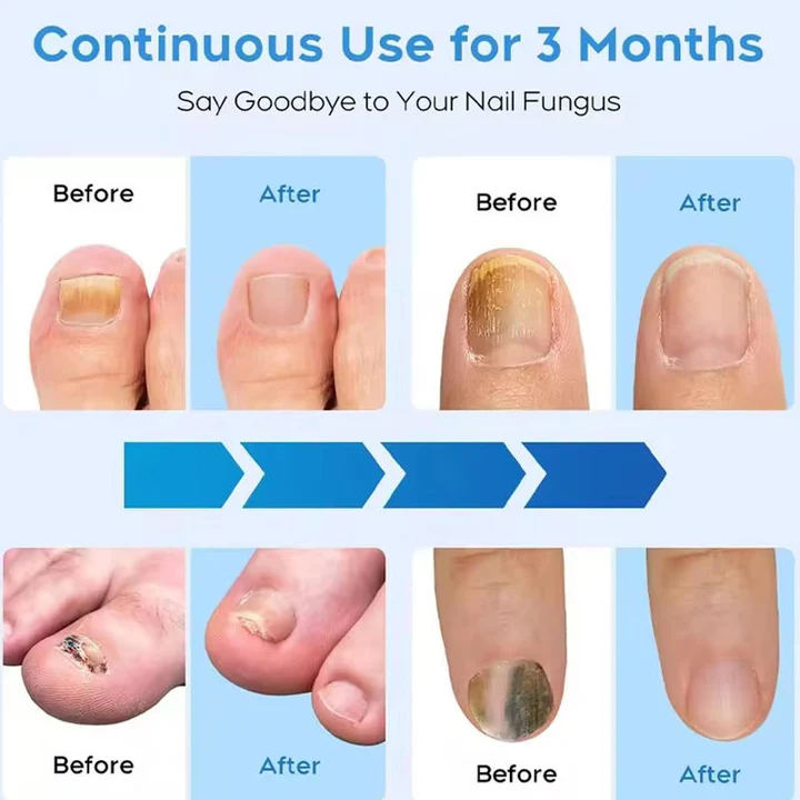 BowLift | Nail Fungus Laser
