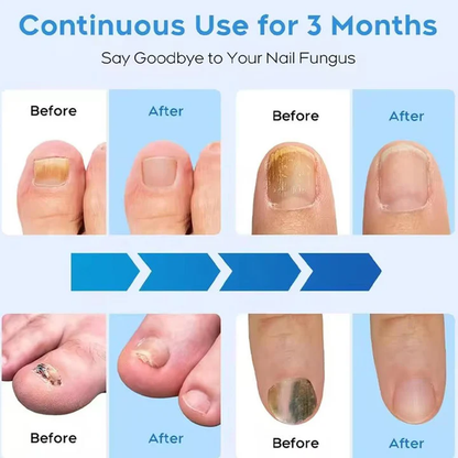 BowLift | Nail Fungus Laser