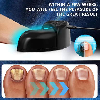 Skanto | Nail Fungus Laser