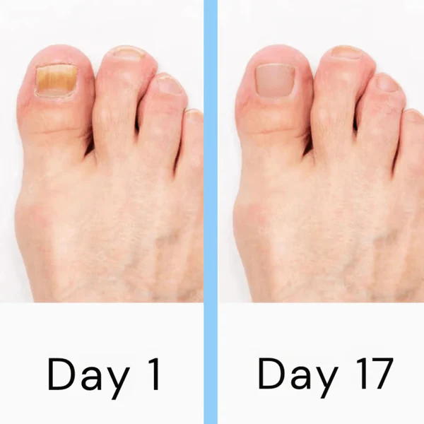 Skanto | Nail Laser Fungus Device
