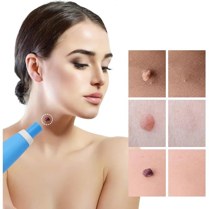 Skin Tag Remover Kit | Non-invasive & Effective | Brehn