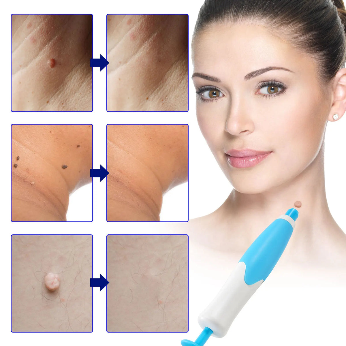 Skin Tag Remover Kit | Non-invasive & Effective | Karnz