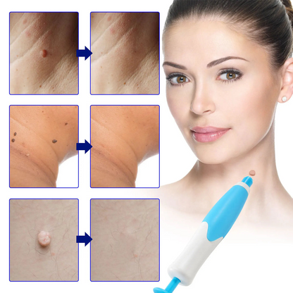 Skin Tag Remover Kit | Non-invasive & Effective | Karnz