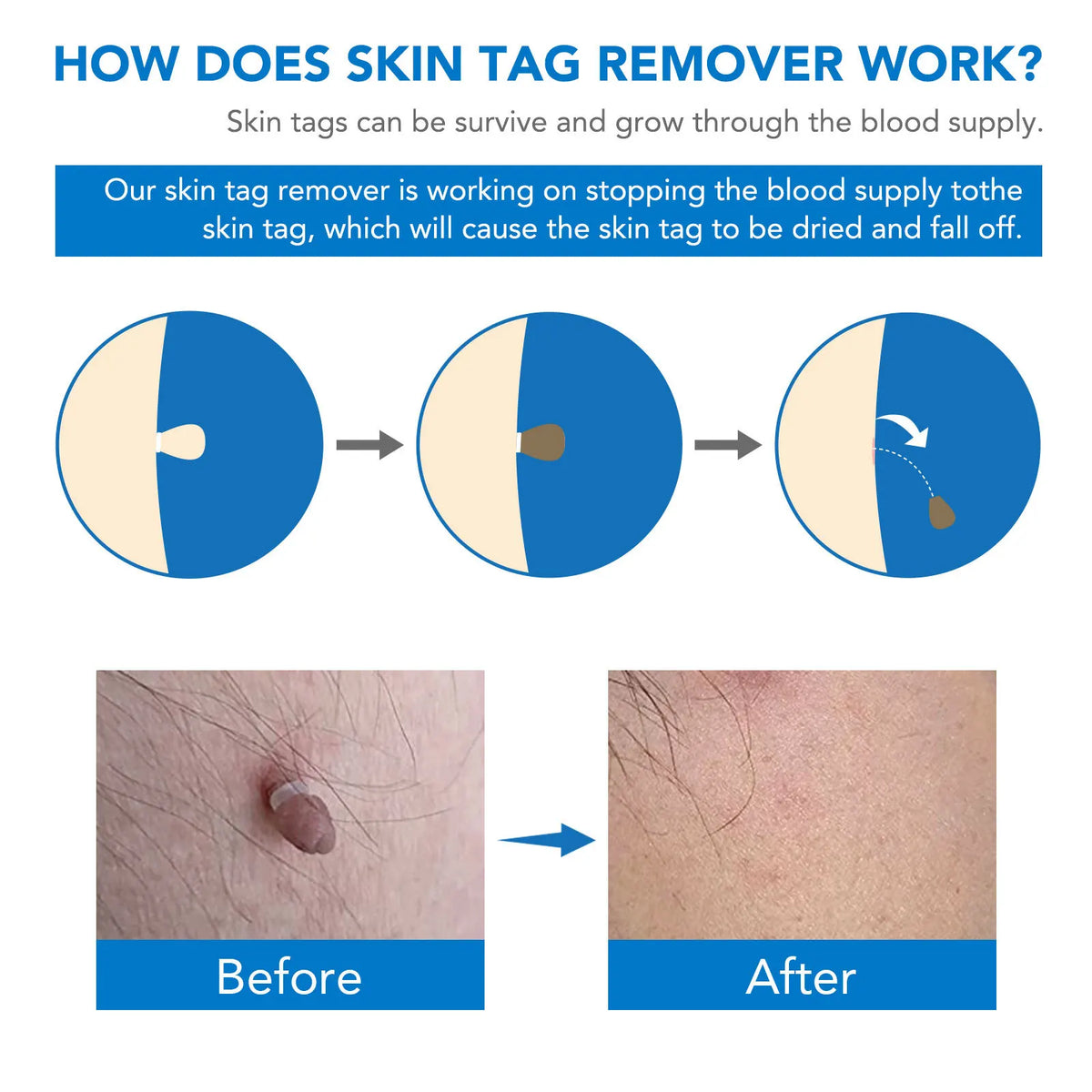 Skin Tag Remover Kit | Non-invasive & Effective | Karnz