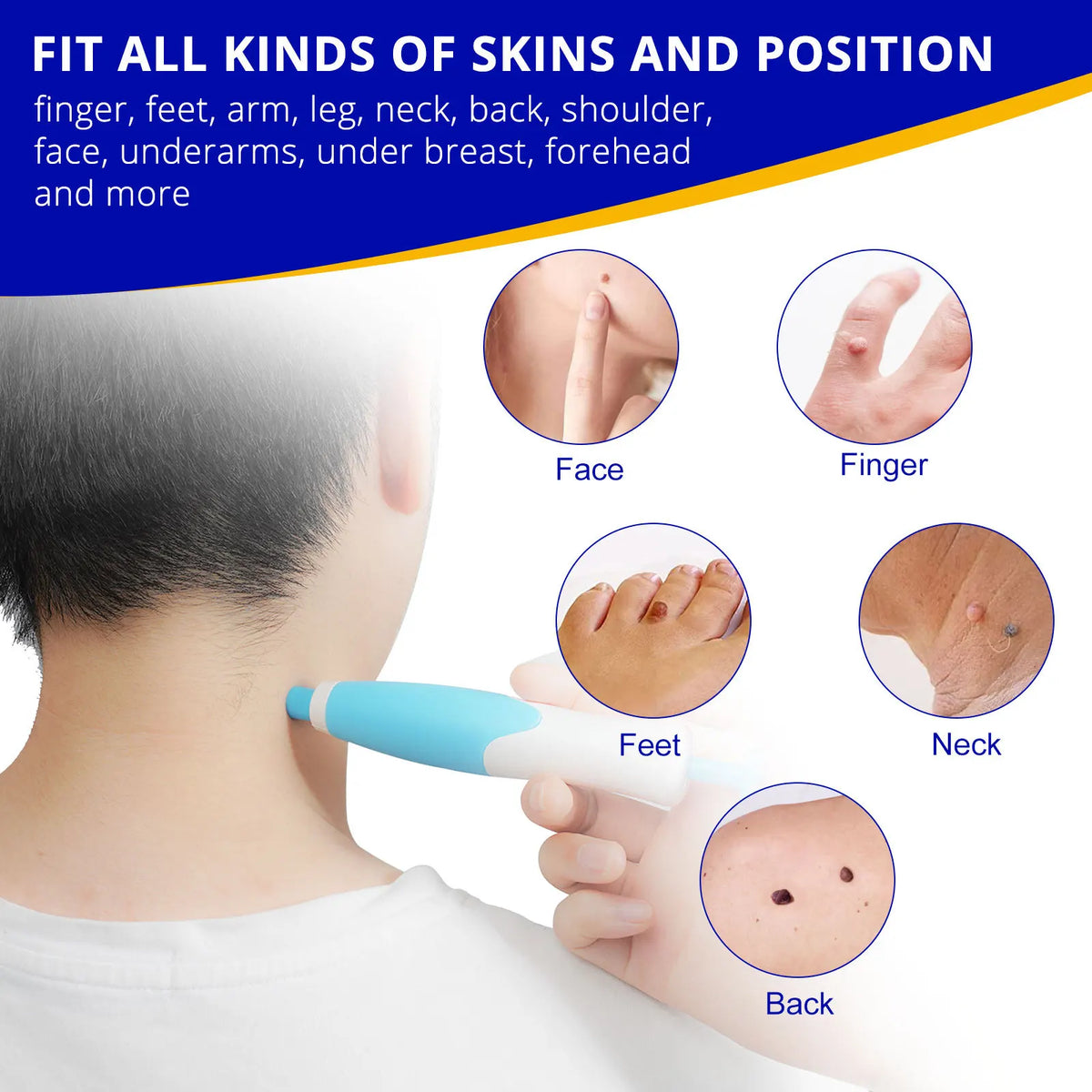 Skin Tag Remover Kit | Non-invasive & Effective | Brehn