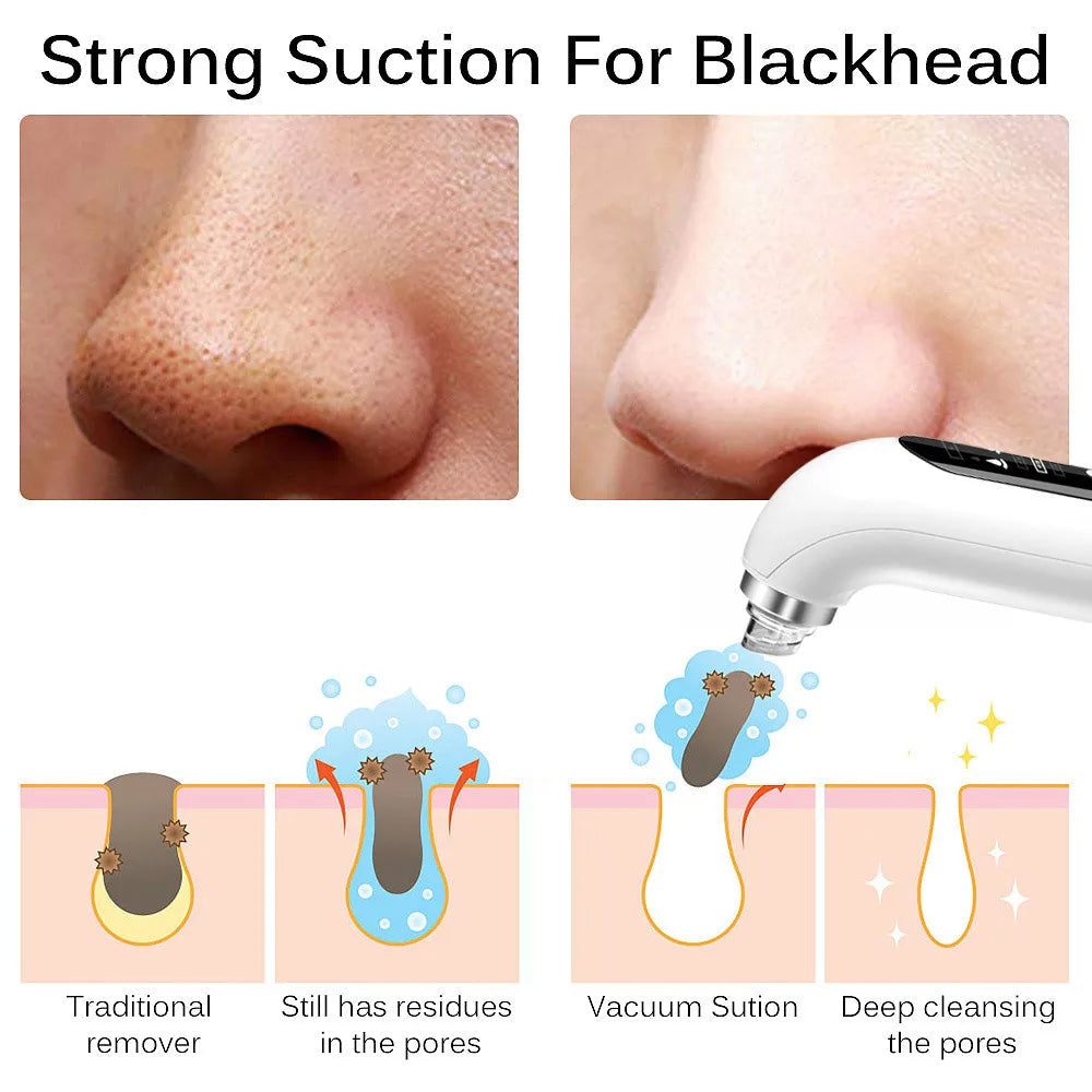 Skanto | Professional Blackhead Remover Vacuum - Deep Cleansing with Suction Technology