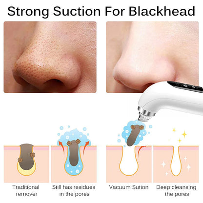 Skanto | Professional Blackhead Remover Vacuum - Deep Cleansing with Suction Technology