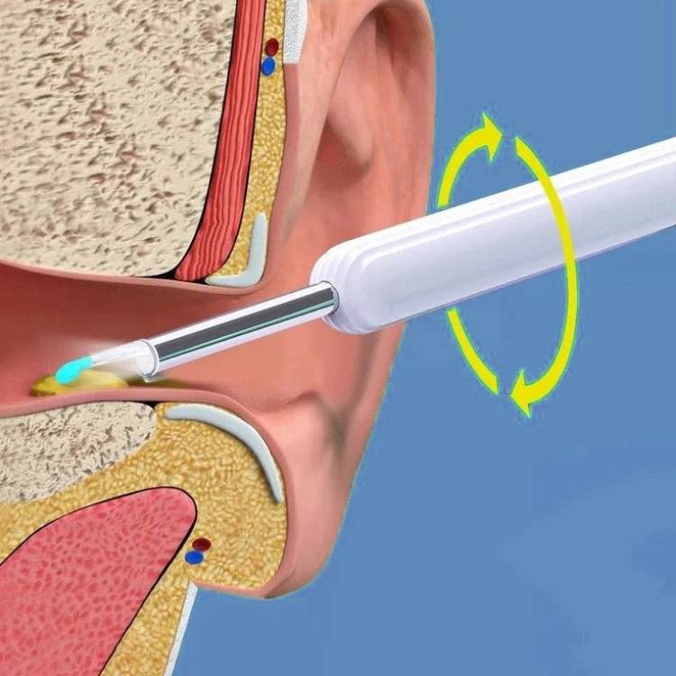 Skanto | EarScope Pro Earwax Removal Kit | High-Definition Camera & LED Light for Safe Home Use