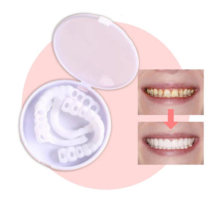 BowLift | SmileSnap - Always the perfect smile with these veneers