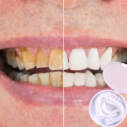 BowLift | SmileSnap - Always the perfect smile with these veneers