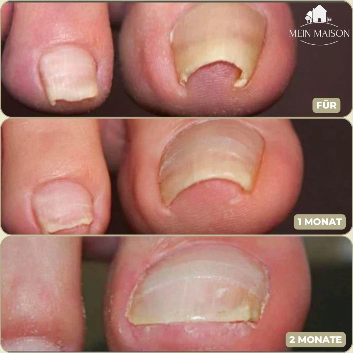 BowLift | ALIGNSTRIP – Painless Nail Correction Strips for Ingrown & Deformed Nails