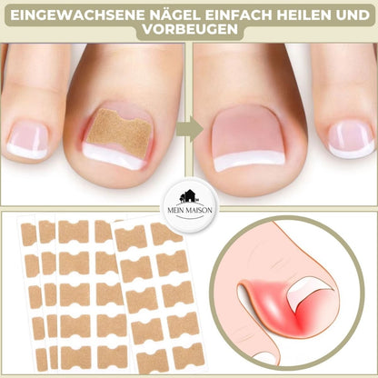 Skanto | ALIGNSTRIP – Painless Nail Correction Strips for Ingrown and Deformed Nails