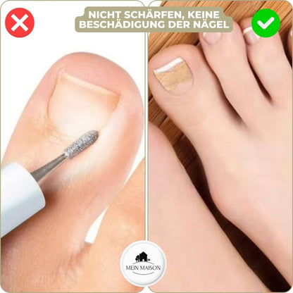 Skanto | ALIGNSTRIP – Painless Nail Correction Strips for Ingrown and Deformed Nails