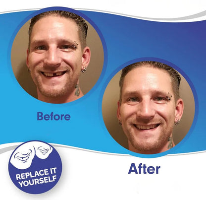 BowLift | Removable Smile Veneers for Upper and Lower Teeth