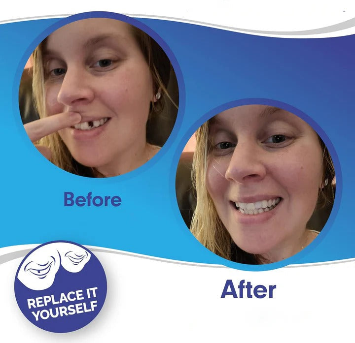 Skanto | Removable Smile Veneers for Upper and Lower Teeth