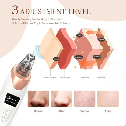 Skanto | Blackhead Remover Vacuum Pore Cleaner | Adjustable Suction, Multifunctional Tool for Deep Cleansing and Acne Treatment at Home
