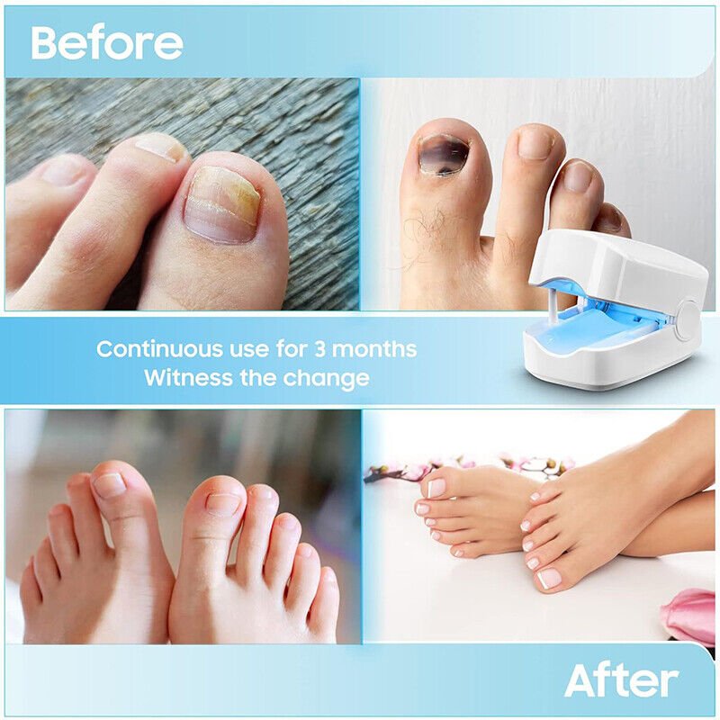Skanto | Laser Nail Fungus Cleaner – Revolutionary, High-Efficiency Light Therapy Device from Expert for Toenail Conditions