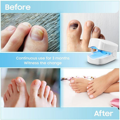 Skanto | Laser Nail Fungus Cleaner – Revolutionary, High-Efficiency Light Therapy Device from Expert for Toenail Conditions