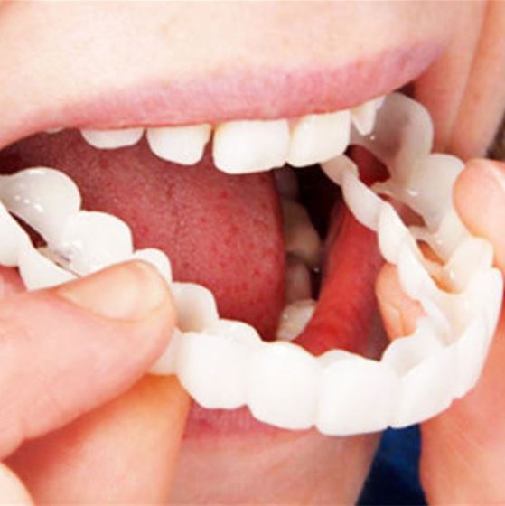 BowLift | SmileSnap - Always the perfect smile with these veneers